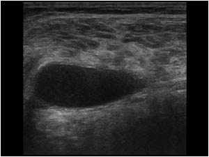 Transverse image of the same anechoic structure between the medial gastrocnemius an the soleus muscle.
The differential diagnosis of a fluid collection between the medial gastrocnemius and the soleus muscle include a hematoma caused by a gastrocnemius mu