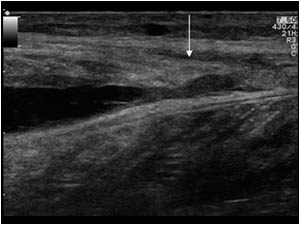 This longitudinal image however shows a rupture with slight retraction of the stump(arrow) surrounded by a hematoma at the distal end of the medial gastrocnemius muscle.