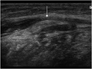 This transverse image shows a rupture with slight retraction of the stump(arrow) surrounded by a hematoma at the distal end of the medial gastrocnemius muscle.
In an uncomplicated case of a medial gastrocnemius muscle rupture or so called tennis leg, the