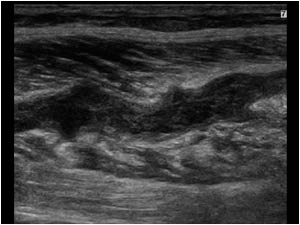 Longitudinal image of the medial gastrocnemius muscle with a non compressible hypoechoic tubular structure.
