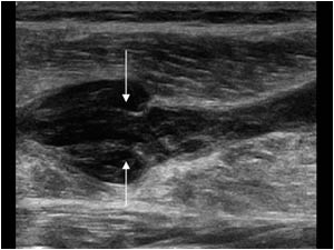 Longitudinal image of the same tubular structure in the medial gastrocnemius muscle slightly more proximal.
There is a local widening of the  structure. The arrows point to the immobile valves in this thrombus filled vein.