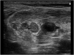 Transverse image of the medial gastrocnemius muscle with non compressible thrombus filled veins.
The thrombosis of the gastrocnemius veins were a complication of the gastrocnemius rupture and could explain the impaired recovery.
In the case of venous th