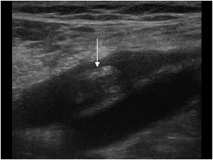 Longitudinal image of the popliteal vessels. The arrow points to a thrombus mass extending into the popliteal vein.