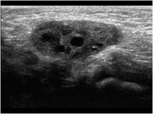 Inguinal hernia with ovary