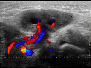 Vascularity in the right ovary