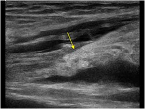 Retracted proximal biceps tendon longitudinal
