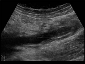 Thrombus filled right ovarian vein  with a thick wall longitudinal