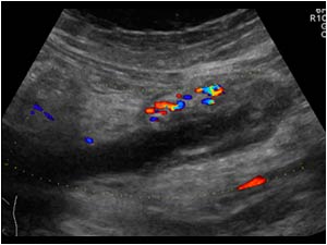 Flow in the wall of the ovarian vein but not in the lumen