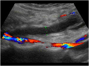 Thrombus filled ovarian vein without flow that mimics a ureter