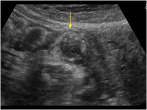 Thrombus filled right ovarian vein next to the uterus transverse