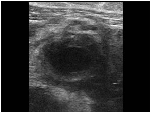 Thrombus filled right ovarian vein with a thick wall that mimics an appendicitis