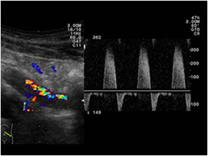 Stenosis with only flow in the true lumen of the iliac artery with high systolic velocity