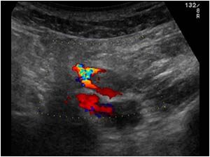 Stenosis with only flow in the true lumen of the iliac artery transverse