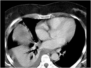 Subphrenic abscess and atelectasis of the lower lobe