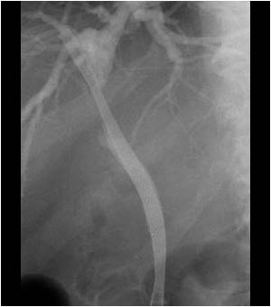 After placing stent