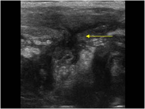 Infiltration of the abdominal wall transverse