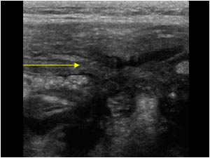 Infiltration of the abdominal wall