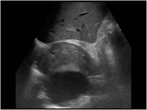 Aneurysm of the proximal abdominal aorta and hematoma transverse