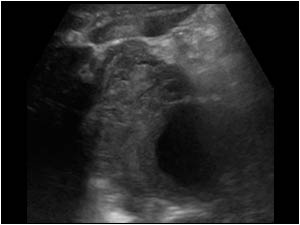 Aneurysm of the proximal abdominal aorta and hematoma transverse