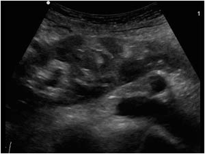 Upperpole of the right kidney longitudinal