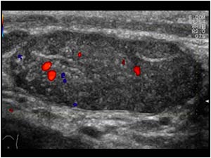 Diminished flow in the atrophic right testis