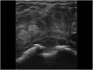 Empty bicipital groove and thick synovium in the bursa transverse