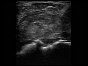 Empty bicipital groove and thick synovium in the bursa transverse