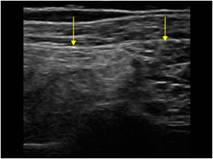 Fatty atrophy of the infraspinatus muscle but not the teres minor muscle