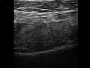 Atrophy of the infraspinatus muscle