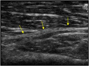Caliber changes of the deep branch of the radial nerve longitudinal