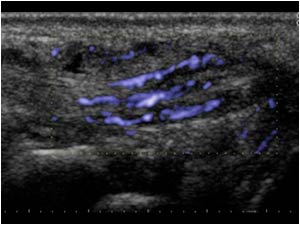 Tenosynovitis of the extensor carpi ulnaris tendon with neovascularity longitudinal
