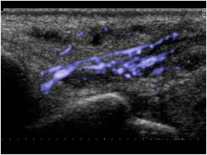 Tenosynovitis of the extensor carpi ulnaris tendon with neovascularity longitudinal