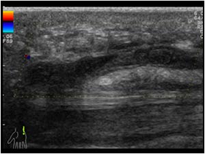 Absent flow in the occluded distal ulnar artery longitudinal
