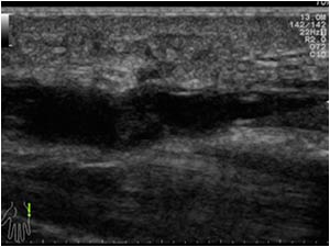 Aneurysmal dilatatated occluded distal ulnar artery longitudinal