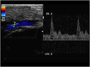 Normal doppler signal in the ulnar artery