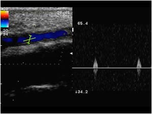 Abnormal doppler signal in the occluded ulnar artery