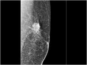 Malignant breast lesions