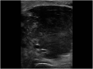 Malignant lymphoma in the knee space transverse