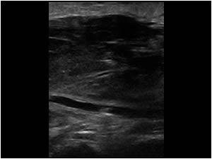 Malignant lymphoma in the knee space longitudinal