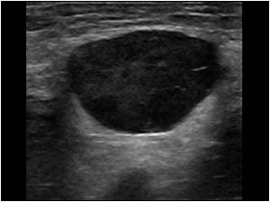 Enlarged lymph node in the groin