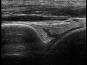 Synovial thickening in the anterior recess longitudinal