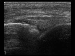 Synovial thickening and slight bony irregularityin the anterior recess longitudinal