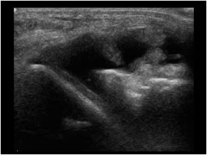 Effusion and synovial thickening in the lateral recess