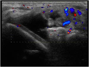 Vascularity of the synovium in the lateral recess