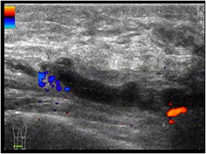 Absent flow in the thrombus filled vein longitudinal