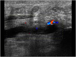 Absent flow in the thrombus filled vein in the ankle longitudinal