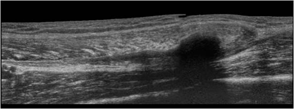 Distal rectus femoris muscle rupture with massive calcification extended field of view longitudinal