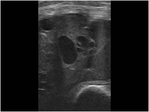 Sarcoma with cystic spaces transverse