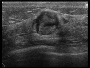 Lesion in the right breast with an inhomogeneous structure