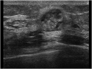 Image of the same breast lesion